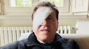 Gianni Morandi sui social con un occhio bendato: “Ho fatto a pugni”