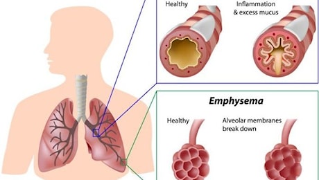 BPCO: cos'è e come prevenirla