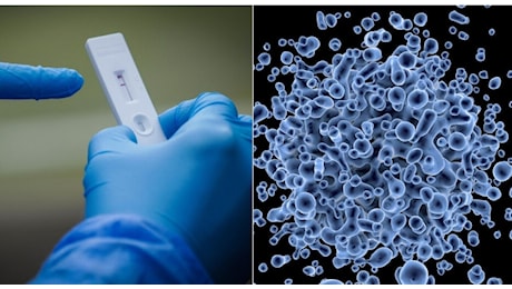 Influenza australiana o Covid: come distinguerli, sintomi e differenze. Vaia: «Virus respiratori pericolosi»