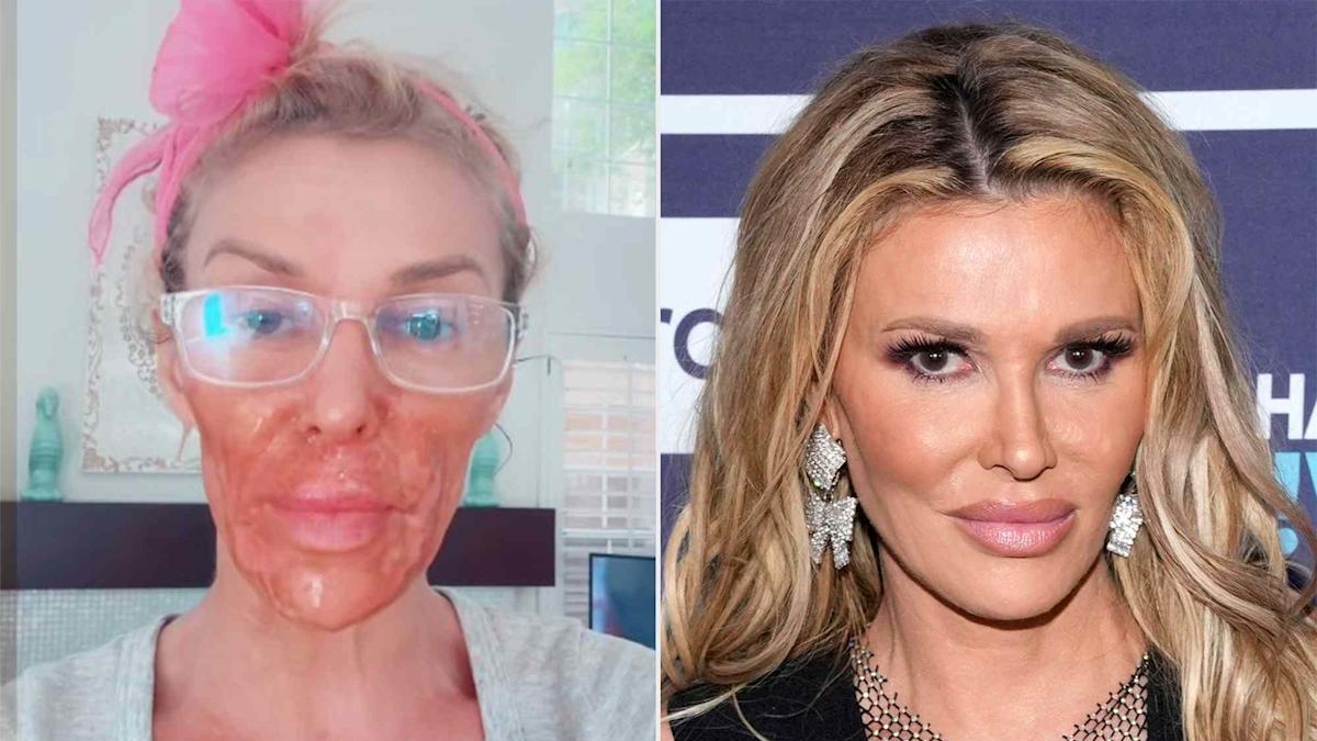 Brandi Glanville, ustioni al viso a causa di un esperimento casalingo: la crema depilatoria per combattere i parassiti facciali
